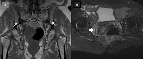 Anahtar Kelimeler: endometriyal hazırlık,depo Gn-RH agonist, dondurulmuş-çözülmüş embriyo transfer SS-064 Parity-related pelvic pain causes detected incidentally in sacroiliac joint MRI; osteitis