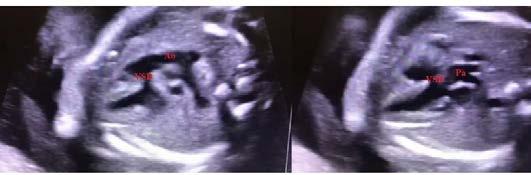 SS-065 Prenatal dönemde tanı konulan Taussig Bing anomalisi Anahtar Kelimeler: Çift çıkışlı sağ ventrikül, Taussig Bing, Ventriküler septal defekt Figür 1: Serenat Eriş Yalçın Sağlık Bilimleri