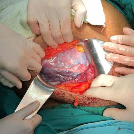 Kaynaklar: 1-U.S. Food and Drug Administration, Urognecologic Surgical Mesh Implants; https://www.fda.gov/medical-devices/implants-and-prosthetics/urogynecologic-surgical-mesh-implants 2- O.