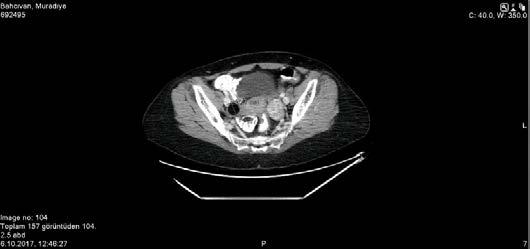 Figür 1 Bilgisayarlı Tomografide sol ovaryan kitle Figür 2 Bilgisayarlı Tomografide sağ ovaryan kist Sezaryen sonrası vaginal doğum ile intrauterin mort fetus doğuran hastanın doğum sonrası