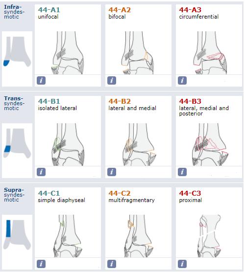 Danis-Weber Tip C Sindesmozun proksimalinde yer alan ayak bileği kırıklarını oluşturan bu grupta sindesmoz yırtılmış olup medial malleolde kırık veya deltoid ligament rüptürü daima eşlik eder.