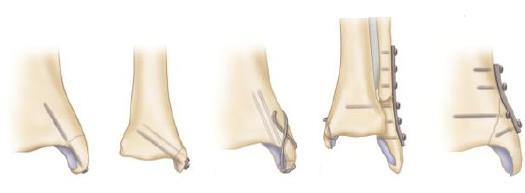 Cerrahi insizyonlar sırasında anteriorda yer alan vena saphena magna ve sinir ile posteriorda yer alan tibialis posterior tendonu korunmalıdır.
