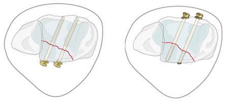 ile kırık hattına ulaşılır. Kırık redüksiyonu sağlandıktan sonra posteriordan anterioru hedefleyen vidalar ile tespit sağlanır.
