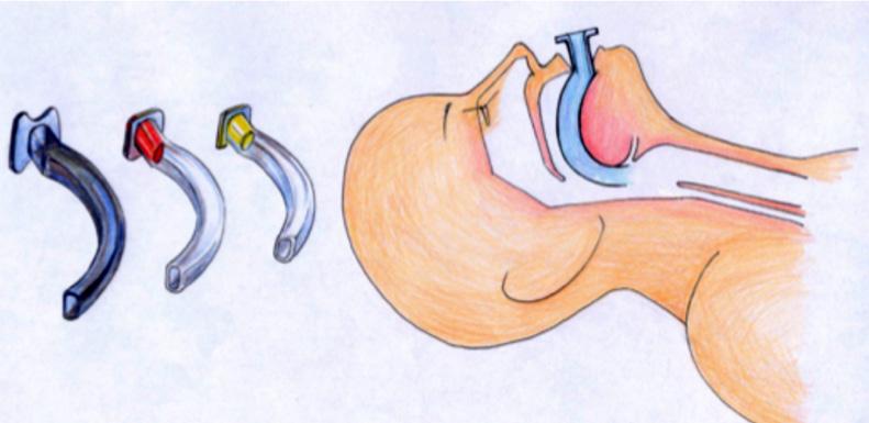 BÖLÜ 16 Havayolu Yönetimi ve Entübasyon 71 Çene İtme (Jaw Thrust) andibula köşelerinin arkasından basınç uygulanarak mandibula tamamiyle öne doğru ittirilir, eş zamanlı olarak dil ve epiglottis öne