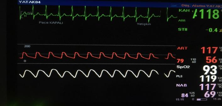 Yeni yayınlanan bir rehber ile normal kalp hızı 50-100/dak olarak tanımlanmaktadır (7).