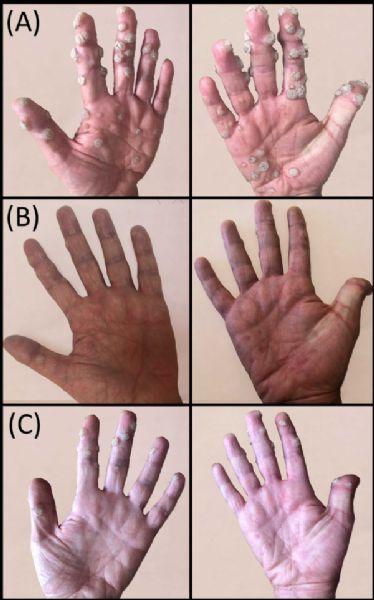 Resim 1 a) SARS-CoV-2 enfeksiyonundan altı ay önceki klinik görünüm; el ve parmaklarda çok sayıda verrüköz papüller