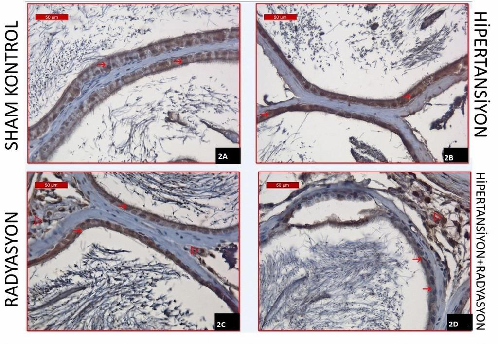Deneysel hipertansiyon modeli indüklenen ve radyofrekans uygulanan grupta özellikle dejenere tübüllere ait epitel hücrelerinde AR tutulumunun diğer gruplara nazaran zayıfladığı izlenirken;
