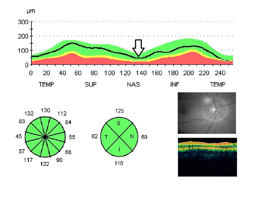 Resim-3: Nonproliferatif diyabetik retinopati grubu olgusunun (NPDR/Olgu 58) retinal
