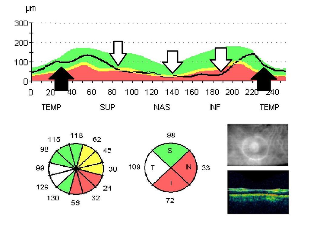 Resim-4: Lazer fotokoagülasyon uygulanan diyabetik retinopati grubu olgunun sağ göz peripapiller retina sinir lifi tabakası değerleri (LFK/Olgu
