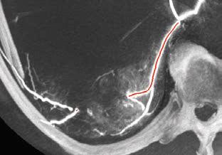 (6C) Konik ışın BT den besleyici damarların fluoroskopik görüntü örtüşmesi, navigasyon sırasında yardım