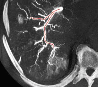 (A) Hepatik arteryal anatomi ve iki lezyon gösteren çölyak arterden ilk planlama DSA sı; (B C) İki