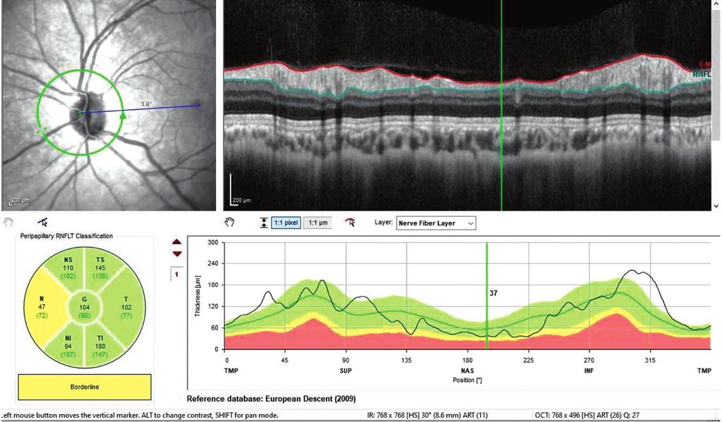 RESİM 6: Hastanın sol gözünün spektral optik koherens tomografi retina sinir lifi tabakası ölçümleri.