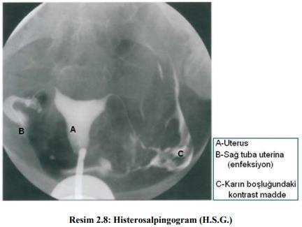 Histerosalpingografide (H.S.G.