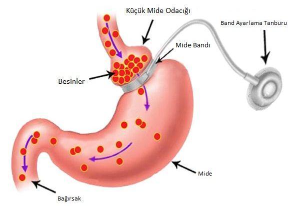 Vertikal bant gastroplasti Ģematik görünümü (100) 1.6.3.1.1.3.Ayarlanabilir Mide Bandı Midenin üst kısmında yaklaģık 20-30 ml lik bir poģ oluģturarak band ile mide hacminin küçültülmesi hedeflenir.