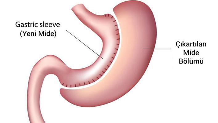 1.6.3.1.1.4. Sleeve Gastrektomi Bu yöntemde ameliyata mide büyük kurvaturuna yapıģık olan omentum diseksiyonu ile baģlanır.