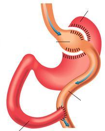 1.6.3.1.3. Kombine kısıtlayıcı ve emilim bozucu yöntemler: 1.6.3.1.3.1. Roux-en-Y Gastrik Bypass (RYGB): Hem kısıtlayıcı hem de emilim bozucu özelliği vardır.