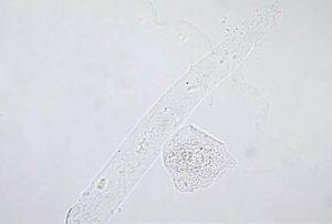 Hyalin Silendir Hyalin silendirler en sık görülen silendirlerdir, tam olarak konsantre olmuş ve sıkıştığı toplayıcı tüpün şeklini almış Tamm-Horsfall mukoproteinidir.