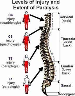 Parapleji nedenleri: Yüksek seviye Spinal Kord
