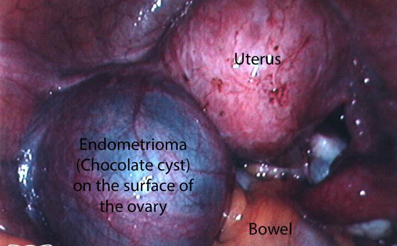 Resim-2: Ovaryan endometrioma(171) Rekto-vajinal adenomyotik nodül (Derin infiltratif
