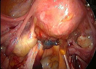 bunlara Endometriyoma denir ve 10 cm e kadar büyürler.