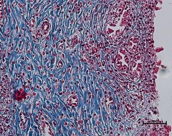 dikkati çekicek şekilde fibrosis ve