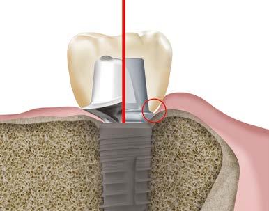 Hastanın yerleştirilen implantının açısına, diş eti şekline ve yapısına, çevre dokularla ilişkisine göre CAD/CAM teknolojisi ile