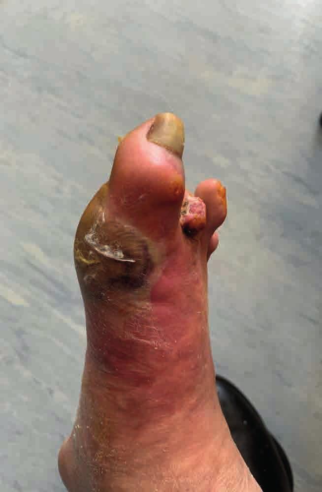 Resim 2b Resim 2c Ayak parmaklarında otoamputasyonlar Sol el palmar yüzde etrafı kallus ile çevrili ülser SONUÇLAR: Lepra tedavisi standart ÇİT ile yeterli sürede yapılmadığında nöral destrüksiyonun
