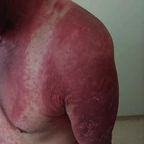 Cutaneous reactions tochemotherapeuticdrugsandtargeted therapy for cancer: Part II. Targetedtherapy. J AmAcadDermatol 2014;71: 217.e1. [PubMed] [Google Scholar] 5.