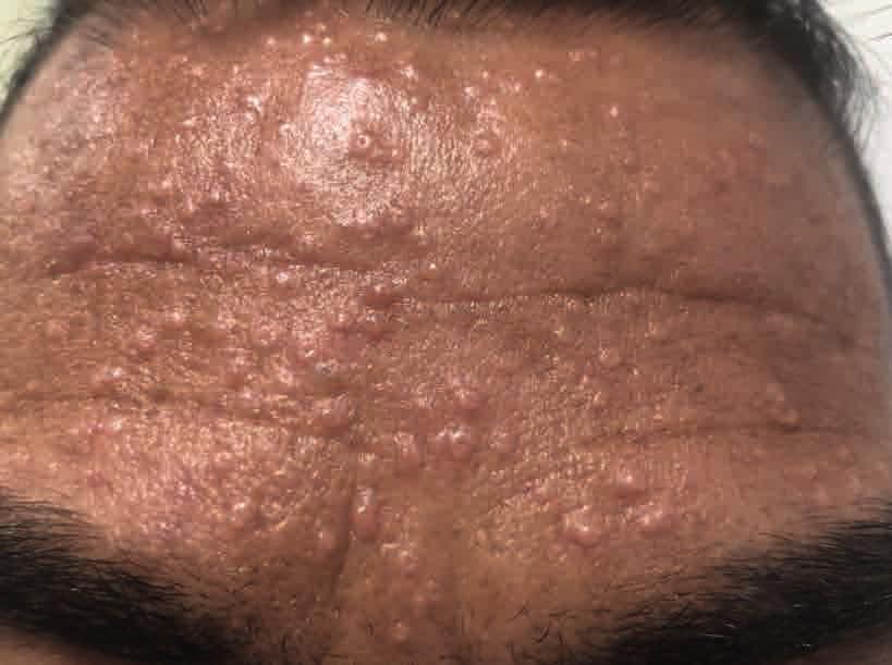 Resim 1a: Alındaki lezyonların klinik görünümü Resim 1b: Yanaktaki lezyonların klinik görünüm Resim 2: lezyonların dermoskopik görünümü