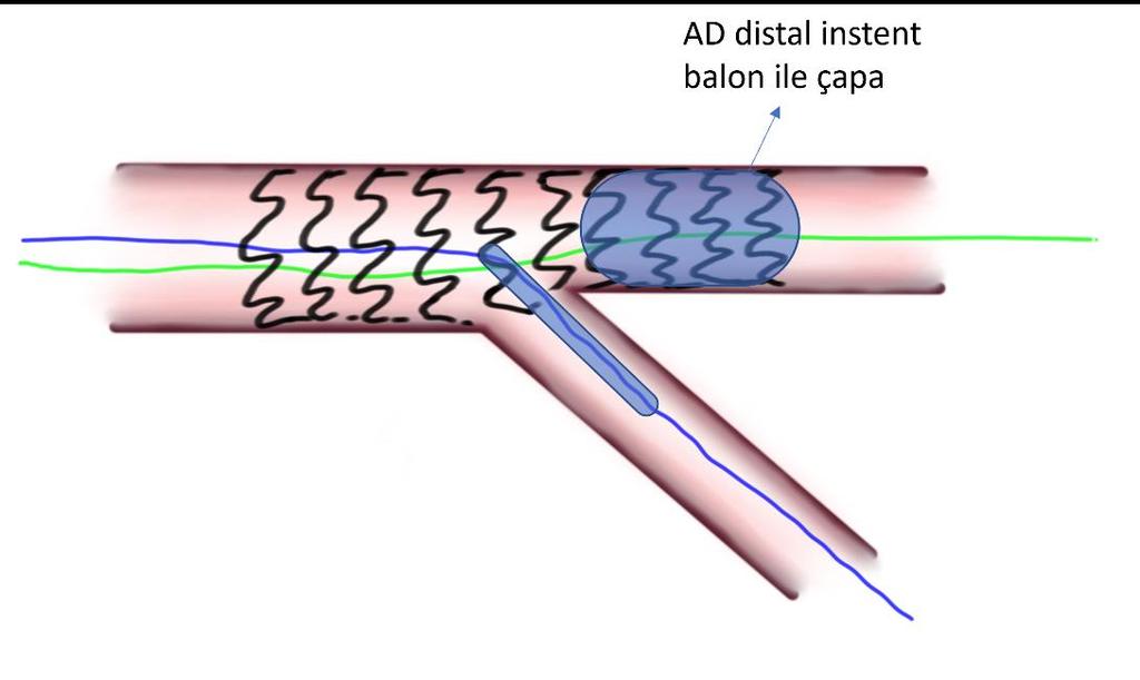 **** YD geçişinde alternatif bir yöntem de düşük profilli balonlar (tek markerlı) kullanmaktır. Yine de başarılamayan olgularda YD telinin başka bir strut aralığından geçirilmesi düşünülebilir.