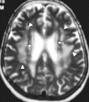 70 yafl nda bayan hastan n MRG sinde T2 a rl kl aksiyel kesitlerde (A) alt ventriküler düzeyde lateral ventrikül frontal hornunu çevreleyen flapka görünümü (oklar) (B) Ayn olguda midventriküler