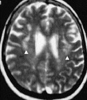 Nörolojik problemi olmayan yafll bayan hastada sentrum semiovale lokalizasyonlu birleflen noktasal T2 hiperintens görünümler (oklar).