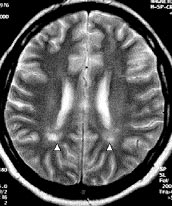Resim 7. Epandimitis granularis. Genç ve sa l kl bayan olguda her iki ventrikül anterioruna komflu hiperintens görünümler (oklar). Resim 8. Terminal hipomiyelinizasyon bölgesi.