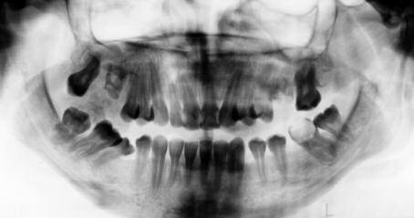 PERİFERAL OSSİFİYE FİBROMA VE TEDAVİSİ Duygu YAZICIOĞLU ve ark. ma lez yon lar ge nel lik le 1-1,5 cm ci va rın da dır, fa kat 6 ve 9 cm bo yut la rın da ki olgu lar da li te ra tür de mev cut tur.