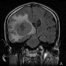 Resim 6. 29 yaşında erkek hasta. Malign B-hücreli Lenfoma olgusu. A. FLAIR sekansta lezyonun nöral parankim ile izointens olduğu, periferik ödemi ve orta hatta shift izlenmekte. B. T2 ağırlıklı imajda kitle santralinin nekrotik olduğu görülmekte.