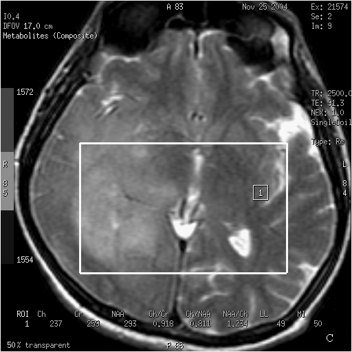 Resim 8. 37 yaşında erkek hasta. Gliomatozis serebri (Gr II) olgusu. A-B. T2 ağırlıklı sekansta sağ serebral hemisferde silik sınırlı, diffüz sinyal artışına yol açan lezyon alanı izlenmekte.
