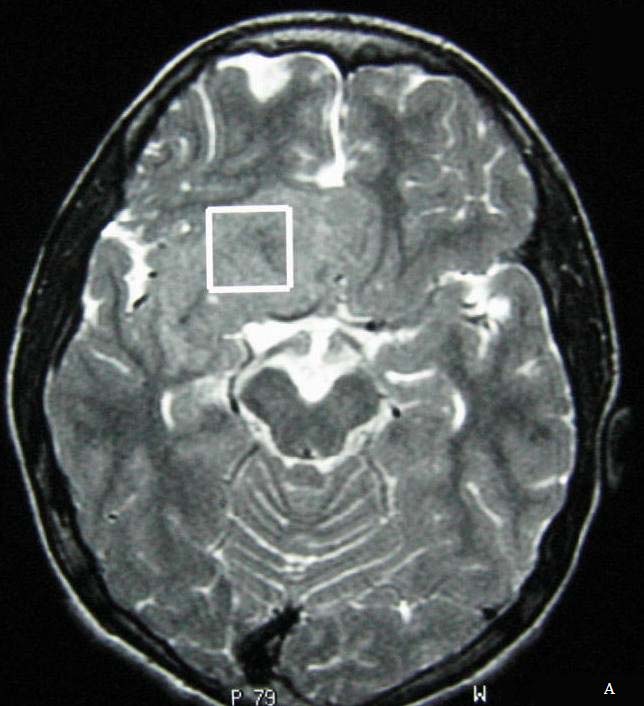 Resim 10. 14 yaşında erkek hasta. Santral nörositom olgusu. A-B.
