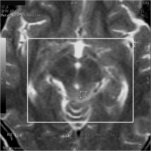Resim11. 20 yaşında erkek hasta. Tektal glioma olgusu. A-B. Radyoterapi öncesi T2 ağırlıklı imajda hiperintens lezyon alanından elde edilen spektrum. C-D.