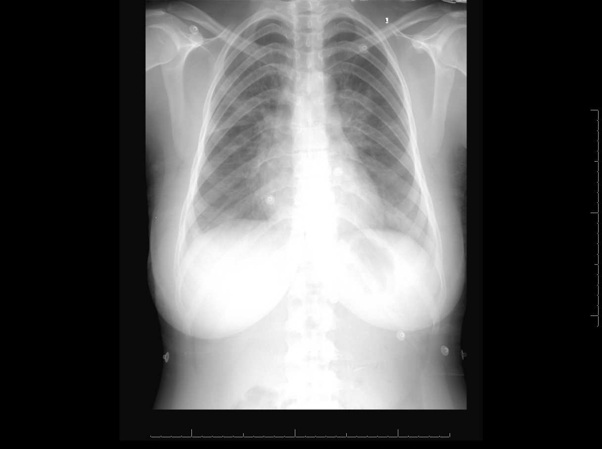 112 KALEMCİ ve ark. anterior akciğer grafisinde her iki akciğerde parakardiyak alanda dansite artışı görüldü (şekil 1).