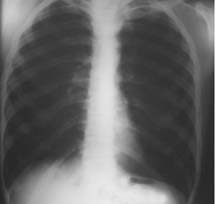 Tanı için altın standart akciğer biyopsisi ise de uyumlu klinik tablo ve SFT bozuklukları tanı için yeterli kabul edilmektedir [3].
