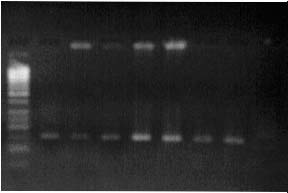 kontrol, M; 50 bç lik DNA Marker ve (14-26) meme CA hasta DNA ürünleri 4.3.3. G i2α nın 179.