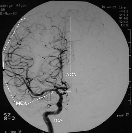 Şekil 3: Internal karotid arter ve dallarının anjiyografik görünümü İSKEMİNİN PATOFİZYOLOJİSİ Erişkin insan beyninin ağırlığı 1500 gramın (g) üzerindedir.