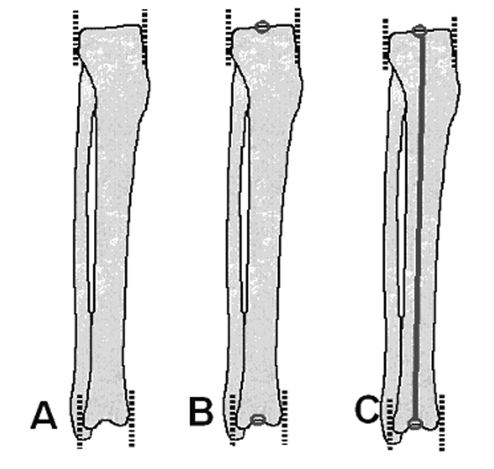 Alt Ekstremite Deformite Analizi (I) 83 O +5 O Þekil 44 a, b: Femur anatomik aksý ile distal femur oryantasyon hattý arasýndaki iliþki; a: Femur anatomik aksý ile distal femur oryantasyon hattý