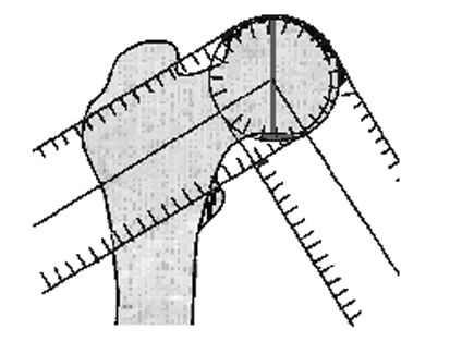 Femur distal eklem yüzünün merkezi: Ýki þekilde bulunabilir: 1. Femoral çentiðin tepe noktasý alýnabilir (Þekil 5a). Femoral çentik, femur distal eklem yüzünün merkezine uyar. 2.