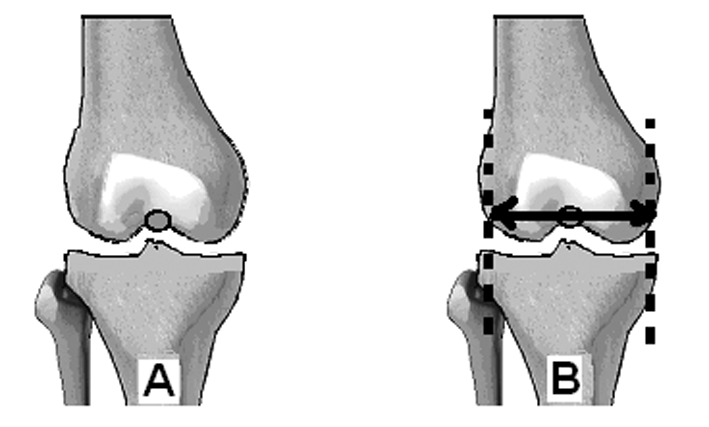 Þekil 6 a, b: Femur eksenleri; a: Mekanik eksen; b: Anatomik eksen. Tibia Mekanik Ekseni Tibia mekanik eksenini çizmek için tibia proksimal ve distal eklemlerinin merkezini bulmak gereklidir.