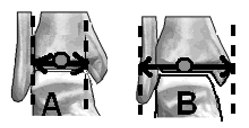 Alt Ekstremite Deformite Analizi (I) 4. Talusun orta noktasý bulunur (Þekil 9b). Þekil 8 a,b: Tibia distal eklem yüzü orta noktasý a: Distal tibia eklem yüzü ortasý; b: Kemiklerin orta noktasý.