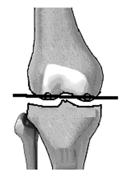 Mehmet Çakmak, Korhan Özkan 1. mlpfa: Femur baþý merkezi ile trokanter tepesini birleþtiren çizgi, femur mekanik ekseni ile lateralde ortalama 90 derece (en az 85, en çok 95 derece) açý yapar.