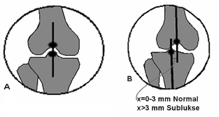 Þekil 31: Trokanter-baþ çizgisi Þekil 34 a, b: Baþ boyun çizgisinin anatomik eksenle iliþkisi, a: Normal kalça; b: koksa vara Þekil 32 a, b: Trokanter-baþ çizgisinin femur mekanik ekseni ile