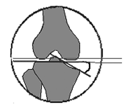 medialde oluþan mlpfa ölçülür. d.normalde 84 derecedir (en az 79, en çok 89). Ayak Bileði MOT Maloryantasyon testi 4 (Þekil 35). a. Distal tibia eklem oryantasyon çizgisi çizilir b.