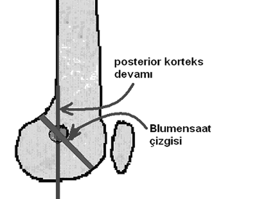 Tibia Anatomik Ekseni Tibianýn diafizine 2 veya 3 yerden dikey olarak çizilen çizgilerin orta noktalarý bulunur, bunlar birleþtirilerek tibia anatomik ekseni çizilir (Þekil 41).